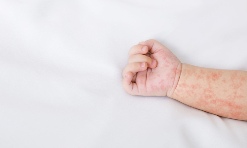 What are the symptoms of food allergy?